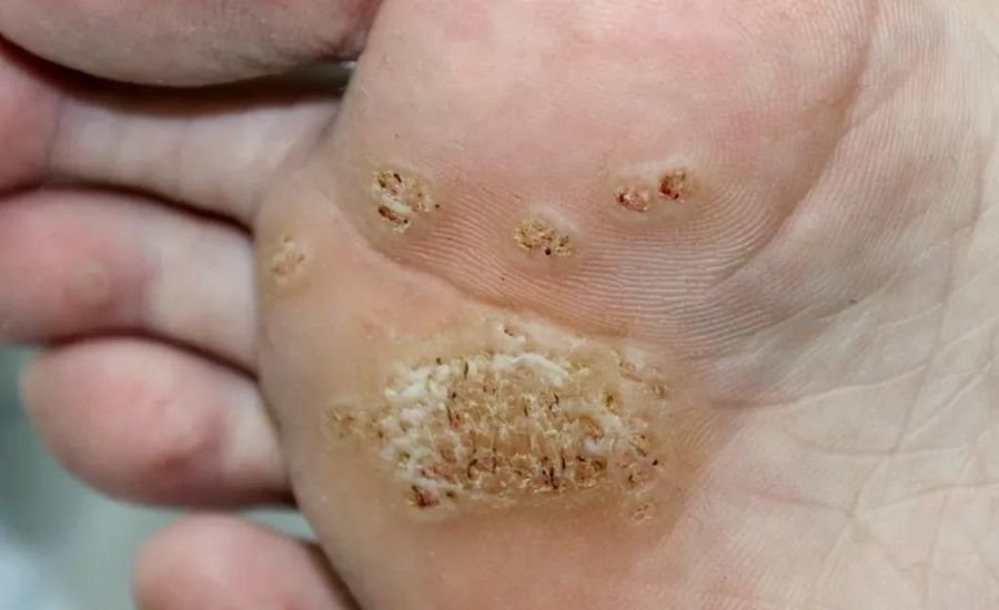 how to remove warts